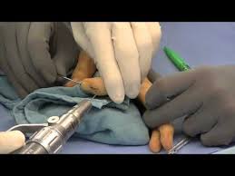 Mallet joint is an injury to the distal interphalangeal, or dip, joint of the finger. Mallet Finger Surgery Preformed By Dr Thomas Trumble Youtube