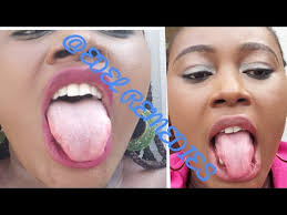 Baking soda is one of the best home remedies for white coated tongue treatment. Best Easy And Natural Way To Get Rid Of White Tongue Permanently Cure Bad Breath 100 Effective Youtube