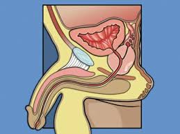 Image result for Radical Prostatectomy