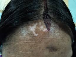 Those with dark skin may notice a loss of color inside their mouths. Vitiligo Article