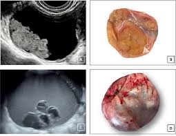 2 primary ovarian cancer and transvaginal and color doppler ultrasonograms of stage i ovarian cancer. Ultrasound Macroscopic And Histological Features Of Borderline Ovarian Tumors International Journal Of Gynecologic Cancer