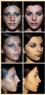 Dott Armando Boccieri Nose Surgery Crooked Nose Rhinoplasty Nose Jobs