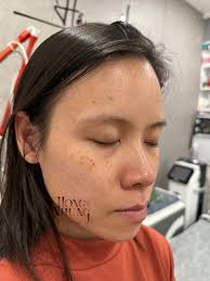 ✓✓ Mùa làm Tàn Nhang đến rồi Thật sự mê lắm ạ, chỉ 1-2 lần là trả da đẹp  lung linh rồi ạ. 👉 𝐋𝐚𝐬𝐞𝐫 𝐩𝐢𝐜𝐨