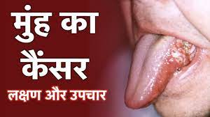 Mouth cancers most commonly begin in the flat, thin cells (squamous cells) that line your lips and the inside of your mouth. Mouth Cancer Hindi 1mg Youtube