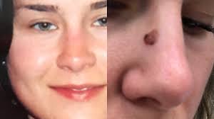 She thought it was just a freckle; it turned into stage 4 melanoma