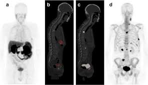 Other noncancerous conditions of the prostate, such as bph or an enlarged prostate, can cause similar symptoms. A 68 Year Old Male With Hormone Resistant Prostate Cancer Gleason Download Scientific Diagram