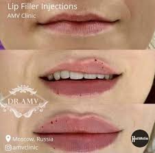 Filler Migration - Best Clinic Sydney For Dermal Fillers