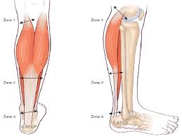 Les cas de chronicisation de la calcification des tendons. Problemes Tendon Achille