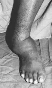Charcot foot syndrome (cfs) is one of the more devastating complications affecting patients with diabetes and peripheral neuropathy. Diabetic Charcot Foot Orthoinfo Aaos