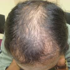 It is more likely that other underlying health factors can contribute to hair loss as well as medication you are taking for uric acid. Pdf Controversy On The Role Of Iron And A Clinical Trial With Intermittent Iron And Nutritional Supplements In Hair Loss Management