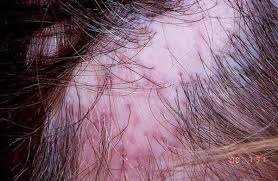 Lichen planopilaris (lpp) is a distinct variant of cicatricial (scarring) alopecia, a group of uncommon disorders which destroy the hair follicles and replace them with scar tissue. Follicular Lichen Planus Lichen Planopilaris
