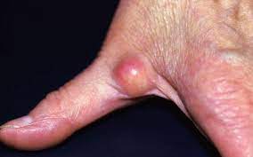 Ganglion Ursachen Symptome Behandlung Onmeda De