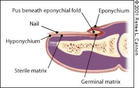 Image result for paronychium