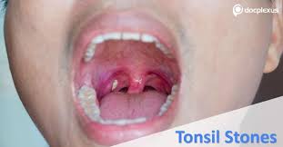Image result for Tonsillolith