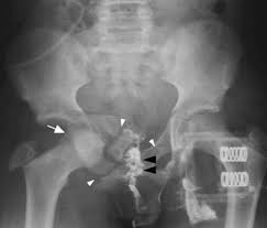 Image result for Retrograde Urethrogram