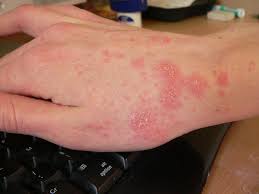 Image result for scabies bite