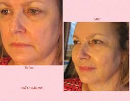 I would like to ask if there is any gentle way to improve my high  cheekbones after my grandmother had her cheekbones shaved..