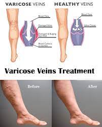 Pin On Varicose Veins Remedies