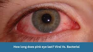 Image result for Viral Conjunctivitis