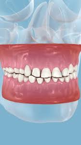 Image result for Tooth Attrition