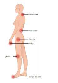 L'arthrose est une maladie des articulations qui provoque la dégradation du cartilage, la prolifération osseuse ou la formation de kystes dans les os. Arthrose Larousse