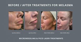 Image result for Melasma