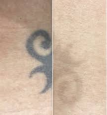 When due to skin conditions. Laser Therapeutics Laser Tattoo Removal