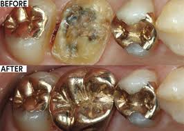 Does a dental crown hurt? Ssqibr4jwsh2ym