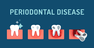 Was man dazu wissen sollte. Parodontitis Buhne Schritte Vektor Illustration Dental Zahnprobleme Vektor Konzept Zahnschmerzen Zahn Tot Schlechte Zahnpflege Arzte Zahnarzte Professionelle Illustration Medizinische Zahnarztliche Zahnerkrankungen Mundprobleme Lizenzfrei