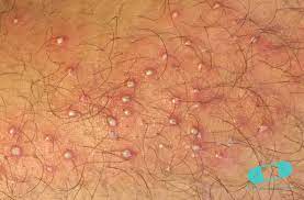 How To Get Rid Of Shaving Rashes - Online Dermatology