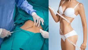 Image result for Liposuction
