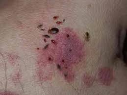 Cliquez ici pour un remède contre les piqûres de fourmis. Que Faire En Cas D Allergies Causees Par Les Piqures De Punaises De Lit