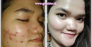 Ibu hamil sering mengalami wajah timbul flek / pigmentasi, atasi dengan krim hn, hamil bukanlah halangan untuk tampil cantik dan menawan ingin kulit mulus, bersih, sehat, cerah dan bebas jerawat?? Amankah Cream Hn Hetty Nugrahati Original Untuk Busui Dan Bumil Cara Memutihkan Wajah Www Grosirhn Id 2017