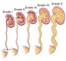 Vesicoureteral reflux is the retrograde flow of urine from the bladder to the kidneys. When Your Child Has Vesicoureteral Reflux Saint Luke S Health System