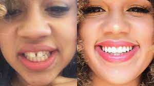 Read our guide on how to fix a gap between your front teeth. Getting My Braces Off Before After Special Retainer For Gaps Youtube