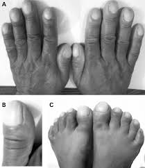 Image result for Clubbing nails feet
