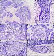 Breast cancer is the second most common cancer found in women — after skin cancer — but that doesn't mean men aren't at risk as well. Basal Cell Carcinoma Wikipedia