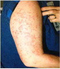 Stills Disease In Adults Adult Stills Bindevevssykdommer Nobindevevssykdommer No