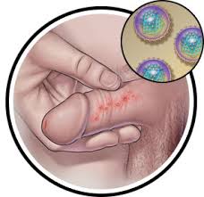 Shingles, also called herpes zoster, is caused by the varicella zoster virus (vzv), which causes chickenpox earlier in life. Herpes Sex U