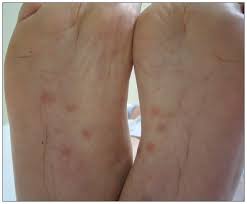 Image result for Secondary Syphilis