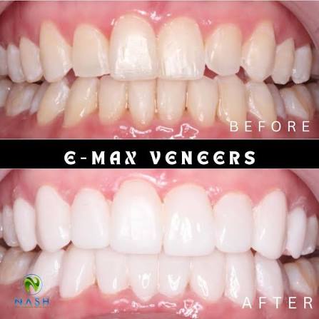 Before and after E-max veneer treatment by Klinik Pergigian Nash