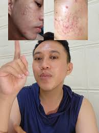 Perawatan Scar dan Jerawat yang Efektif