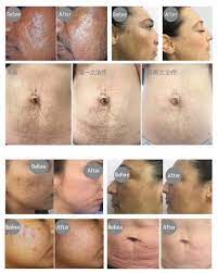 A fan to fan marketplace where you can safely, buy and sell real tickets. Narbe Akne Stretch Marks Entfernung Gesicht Heben Haut Verjungung Thermische Fractional Tixel Home Use Beauty Devices Aliexpress