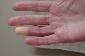 If those options don't work and you feel a raynaud's attack coming on, you can try moving to a warmer spot, warming your hands and feet by putting your hands under your armpits. 10 Causes Of Cold Fingers Hands Why Are My Fingers Always Cold