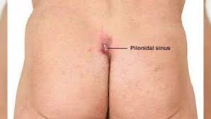 Just like another skin cyst, an ingrown hair cyst lies underneath. Pilonidal Sinus Treatment Op Dr Cetin Altunal