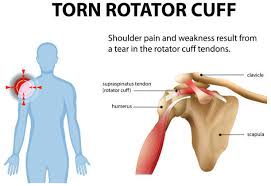 Image result for Rotator Cuff Injury