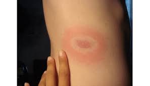 Maybe you would like to learn more about one of these? Maladie De Lyme Fatigue Paralysie Meningite On Ne S En Debarrasse Jamais Le Plus