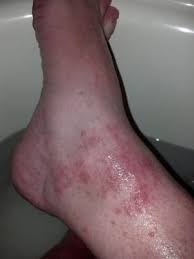 Pin On Rash