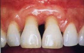 Maybe you would like to learn more about one of these? Can A Waterpik Reverse Gum Disease The Toothsayer Uk