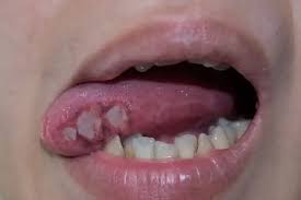 Image result for cancer of tongue